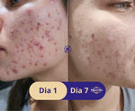 Kit Pele Oleosa e Anti-Acne
